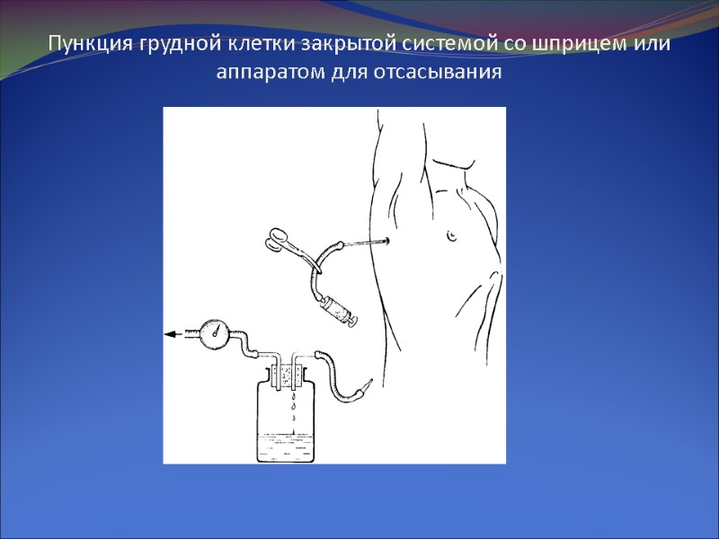 Пункция грудной клетки закрытой системой со шприцем или аппаратом для отсасывания